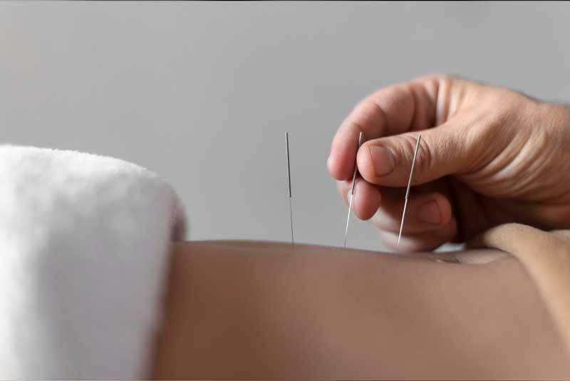 Fine acupuncture needles placed by a practitioner